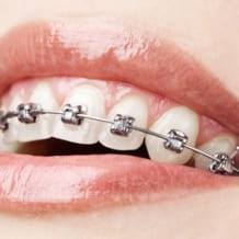 Orthodontics Braces