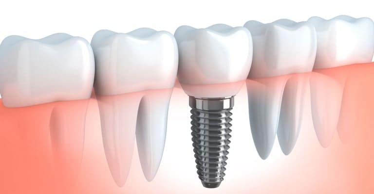 Tooth Implant - Miami or Coral Gable Dental Office