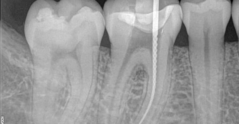 Root Canal - Miami or Coral Gable Dental Office