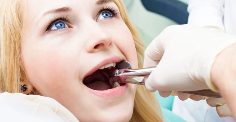 Tooth Extraction - Miami or Coral Gable Dental Office
