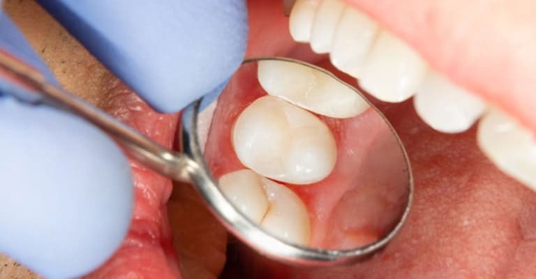Dental Sealants - Miami or Coral Gable Dental Office
